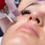 Prp Microneedling London Uk | Thecheclinic.co.uk