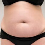 Vitiligo Skin Tone Correction UAE – Natural, Balanced Results