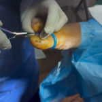 Fungal Nail Treatment: Same-Day Care at UK Nail Surgeon