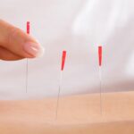 Acupuncture in Royal Oak — Expert, Gentle Treatments
