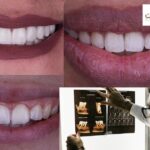 حشوات الأسنان الأمامية التجميلية: ابتسامة أكثر إشراقاً بثقة