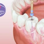 Blanqueamiento Dental Gines: somriure brillant amb confiança