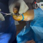 Effective Fungal Nail Treatment: Quick, Comfortable Care